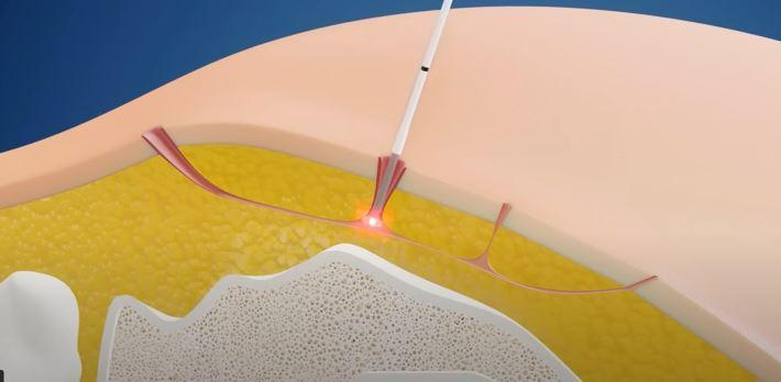 Illustration of minimally invasive laser treatment for pilonidal disease