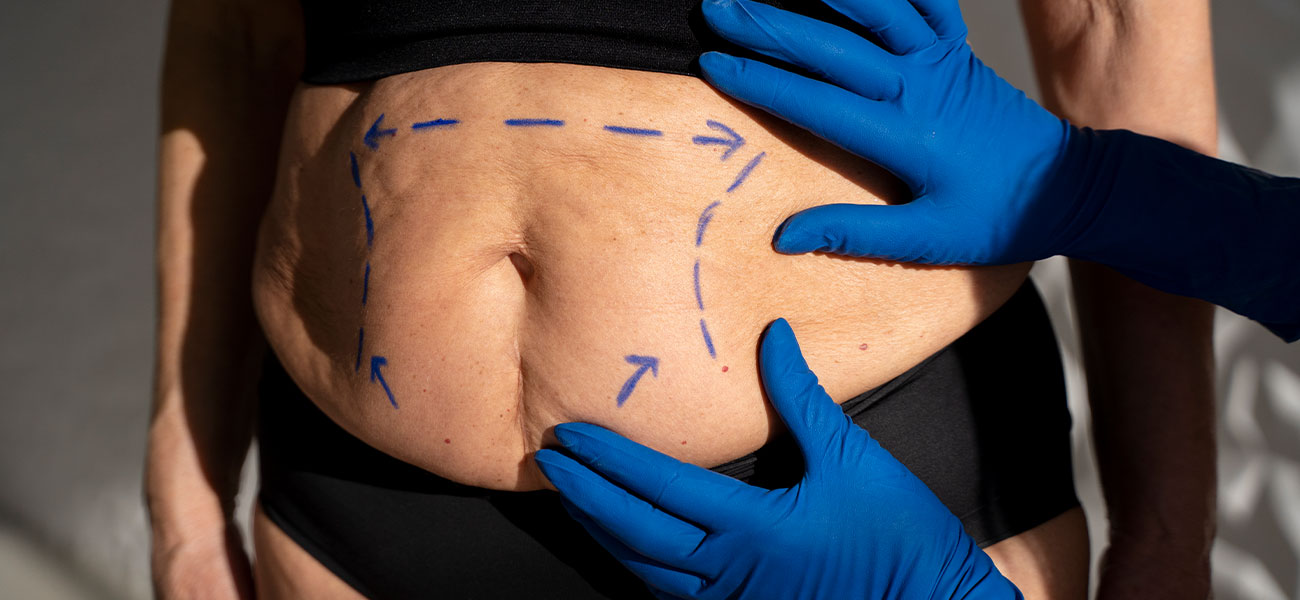 Clinical assessment markings for bariatric and abdominal surgery