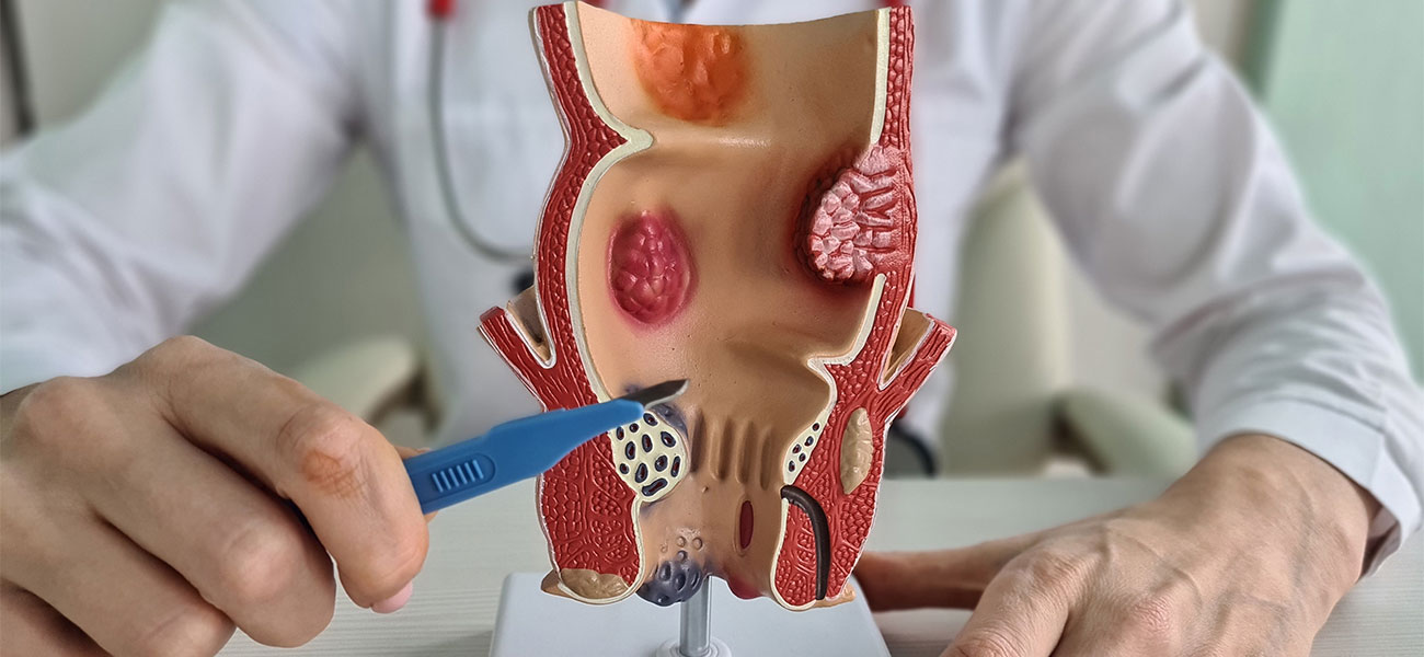 Anorectal anatomy model used during a proctology consultation